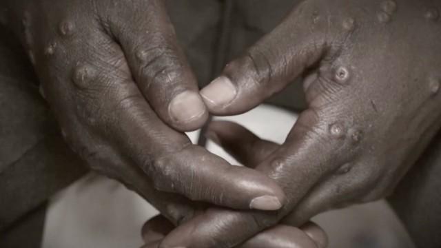 Mpox: Another test for vaccine equity