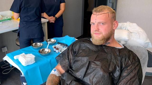 Haartransplantation gegen Halbglatze