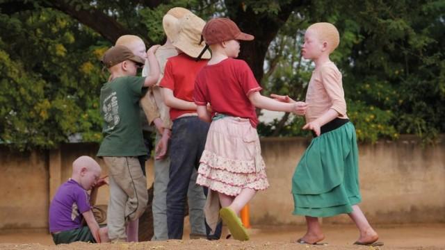 Tanzanie : l'enfance volée des albinos